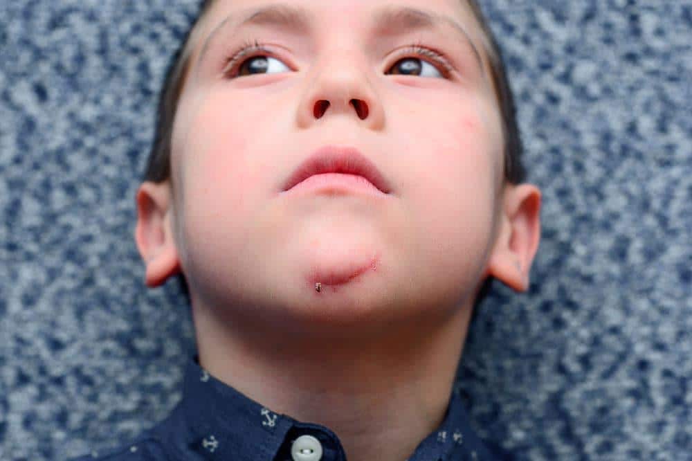 boy with scar