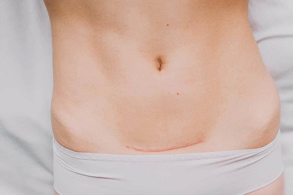 woman with cesarean